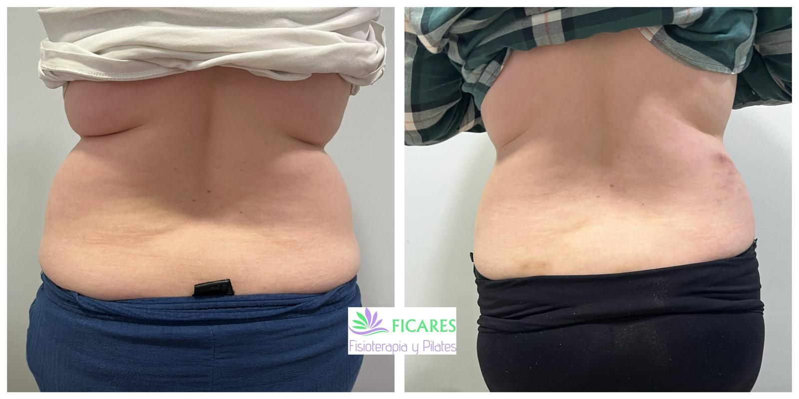 Vista del antes y el después de la espalda baja de una persona. El "después" muestra una reducción de grasa.