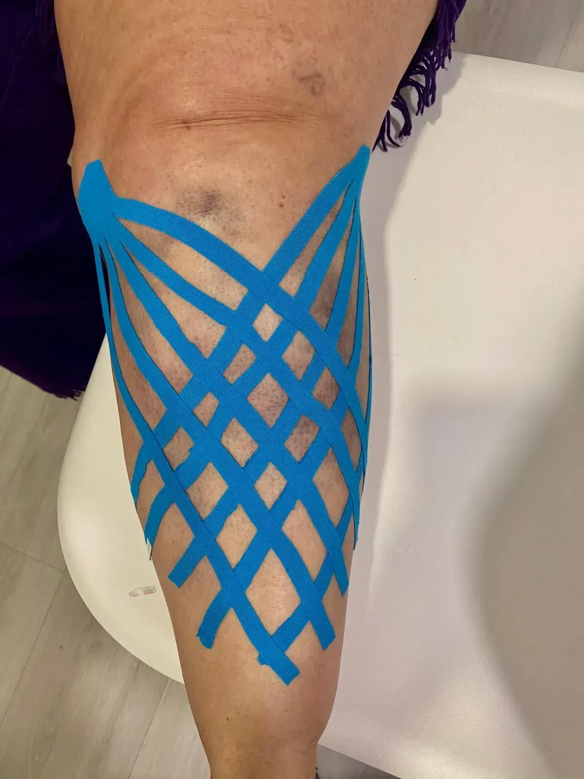 Pierna con cinta kinesiológica azul aplicada en forma entrecruzada, probablemente para apoyo o alivio del dolor.