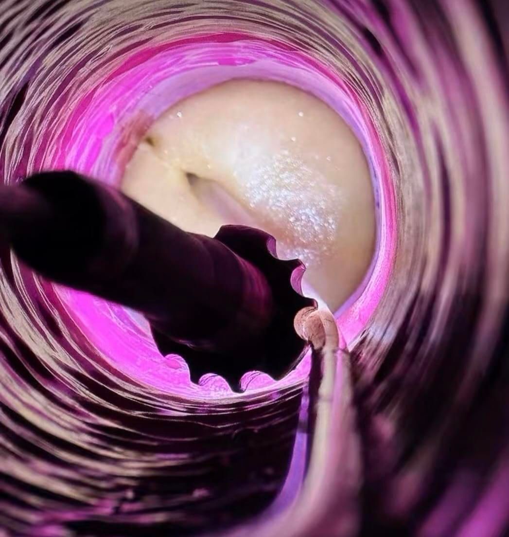 Instrument médical à l'intérieur d'une cavité corporelle illuminée en rose, près d'une structure blanche arrondie.