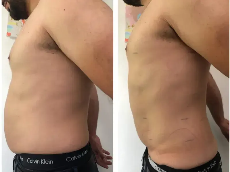 Ein Vorher-Nachher-Bild des Oberkörpers eines Mannes.