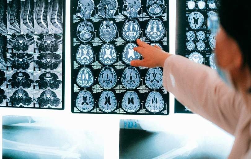 Una persona señala un escáner cerebral en la pantalla de una computadora.