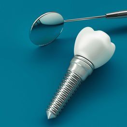 Implantologie - Cabinet Dentaire de Rumine