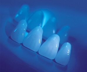 Primer plano de carillas dentales blancas sobre una bandeja, iluminadas con luz azul