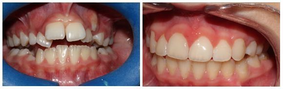 Una fotografía de antes y después de los dientes de una persona.
