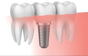 Una ilustración de un implante dental entre dos dientes.