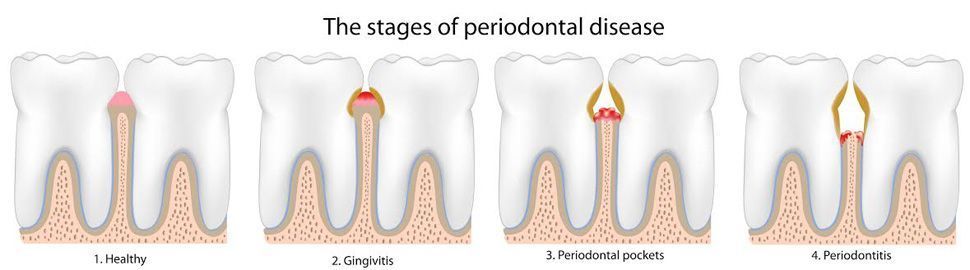 Un diagrama de las etapas de la enfermedad periodontal.