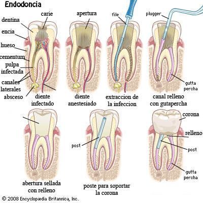 Diagrama de un diente que se extrae de la boca.
