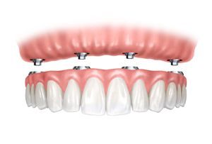 Un primer plano de una dentadura postiza completa con aparatos ortopédicos.