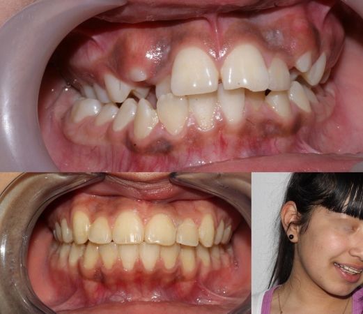 Un primer plano de los dientes de una persona y un primer plano de la cara de una niña.