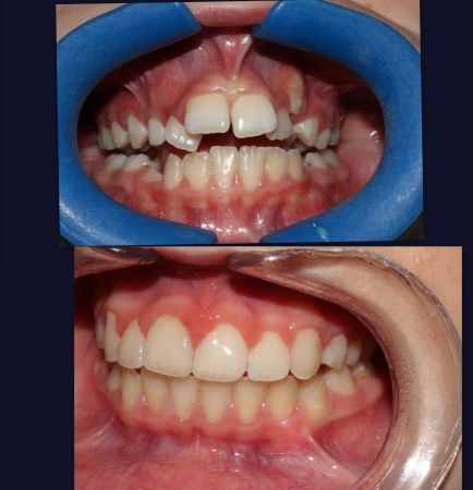 Un primer plano de los dientes de una persona con un protector bucal azul.