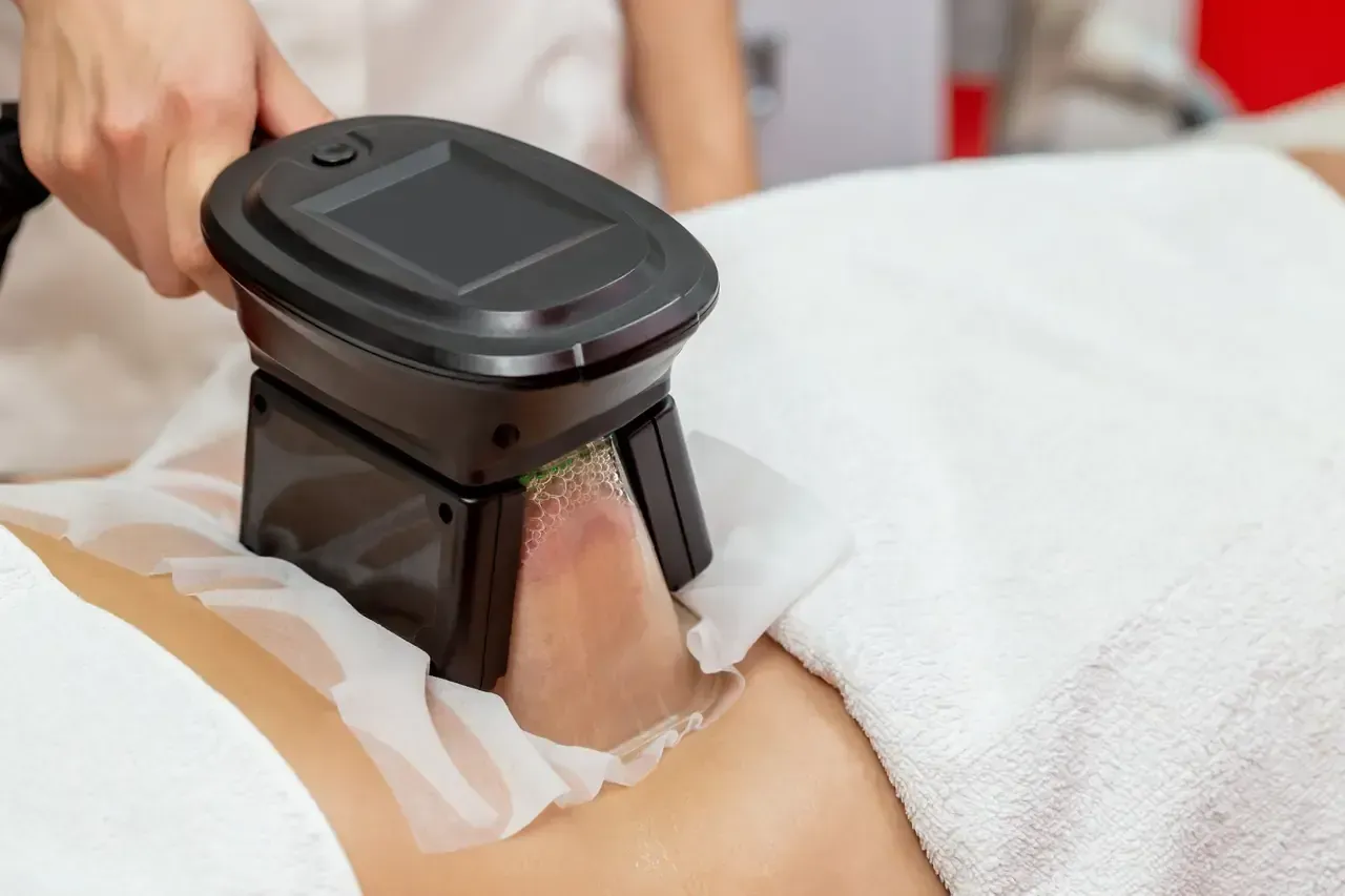 Persona recibiendo tratamiento de criolipólisis. Se utiliza un dispositivo en el abdomen, y se ve la mano del profesional.