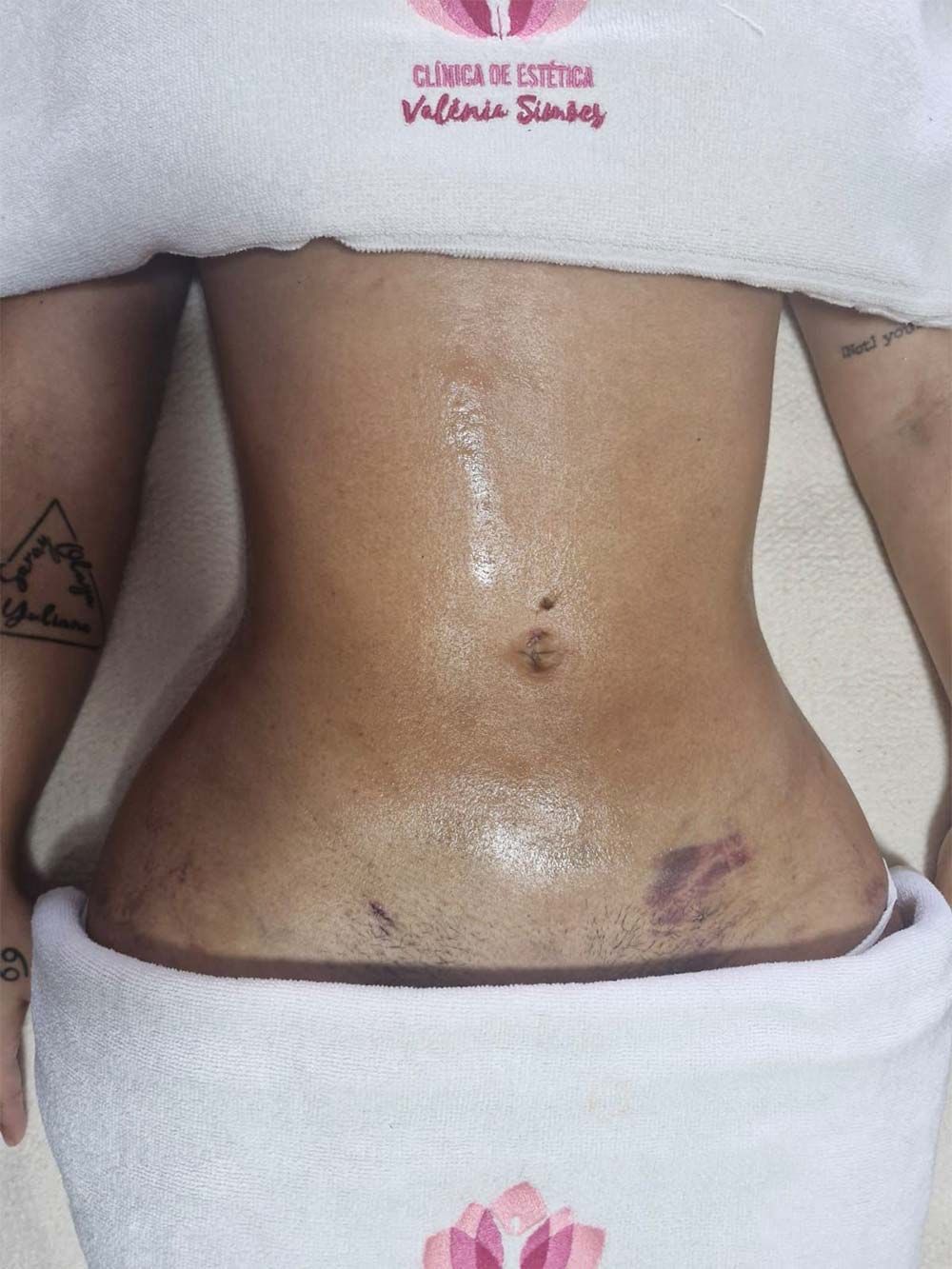 Torso de una persona con la cintura ceñida; la piel está amoratada y tiene residuos de aceite.