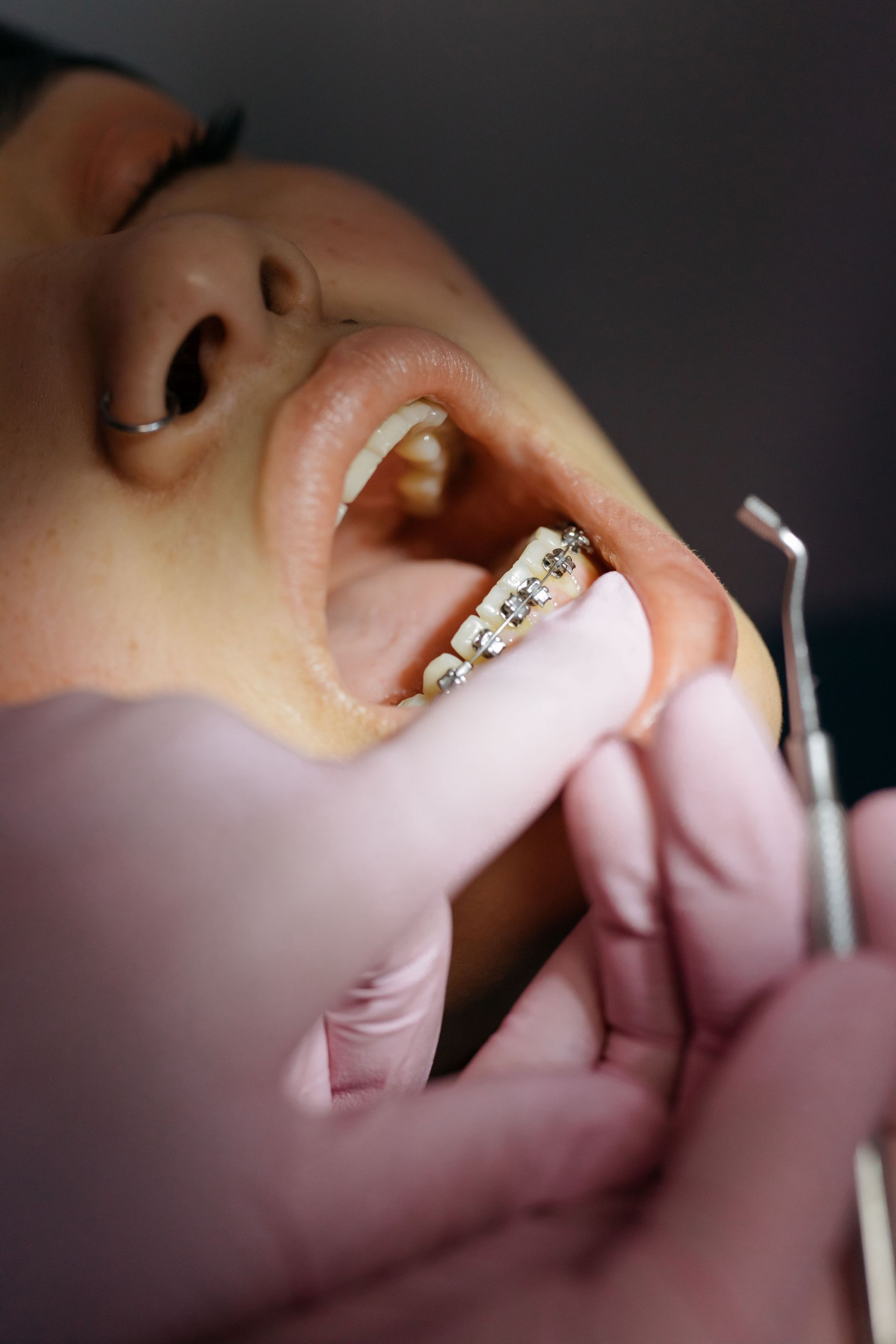 Primer plano de una boca con aparatos de ortodoncia mientras unas manos utilizan un instrumento dental para ajustarla.