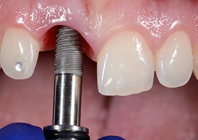 Un primer plano de un implante dental en la boca de una persona.