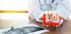Un dentista sostiene un modelo de un implante dental en sus manos.