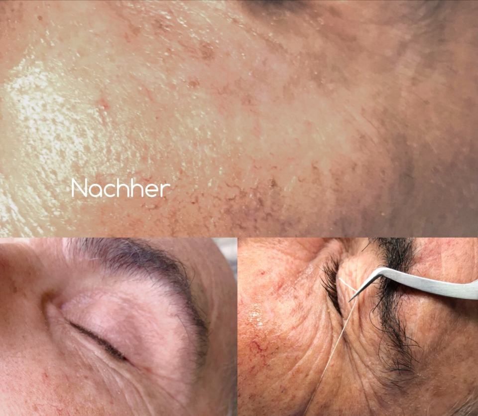 Kosmetikbehandlung Seidenfadenlifting