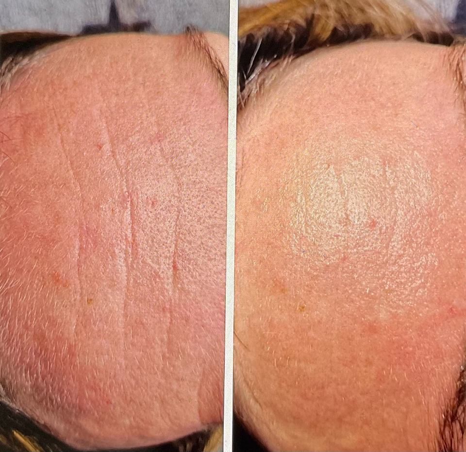 Kosmetikbehandlung Stirn