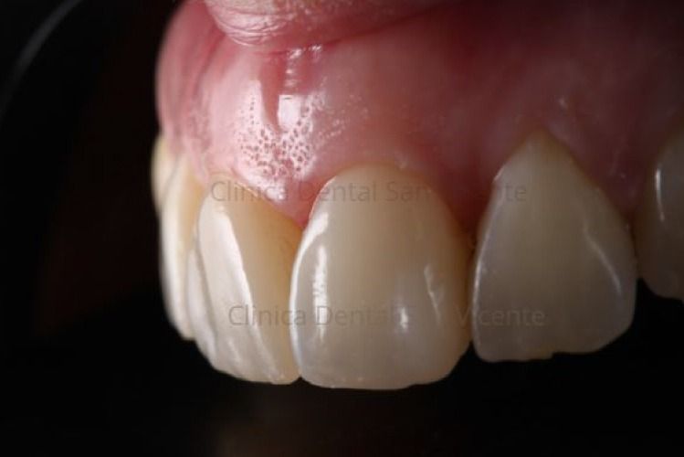 Un primer plano de los dientes de una persona con un fondo negro.