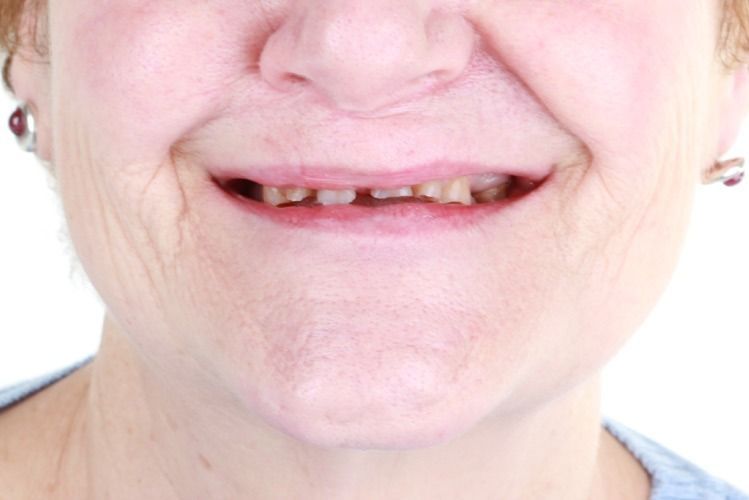 Un primer plano de la boca de una mujer sin dientes.