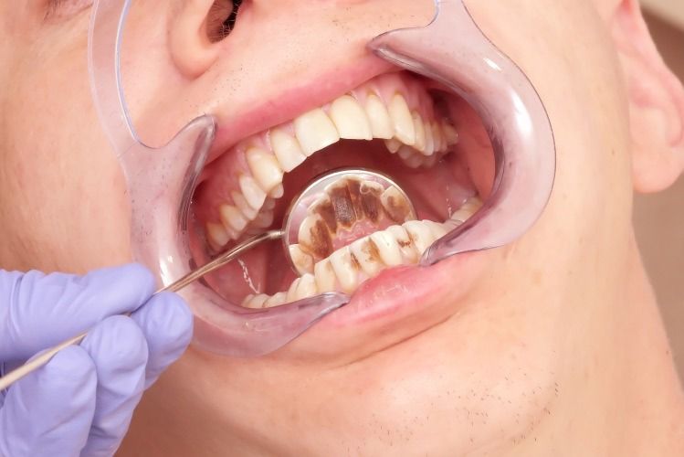 Un hombre está siendo examinado por un dentista.