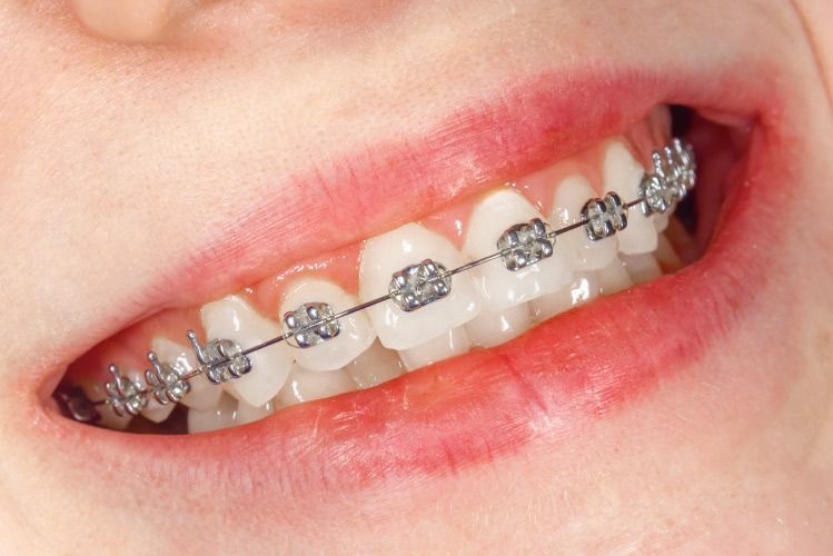 Un primer plano de los dientes de una persona con aparatos ortopédicos.