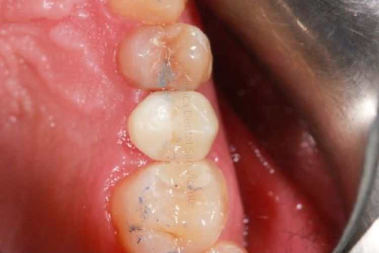 Un primer plano de los dientes de una persona con un objeto metálico en el fondo.