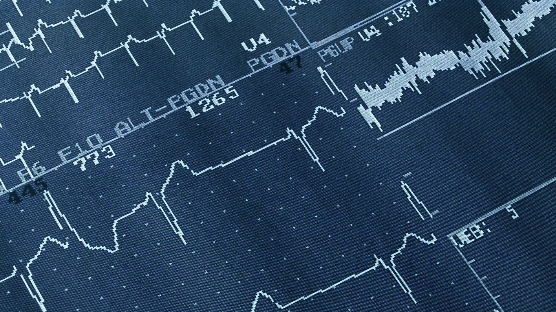Électrocardiogramme T-PGDN
