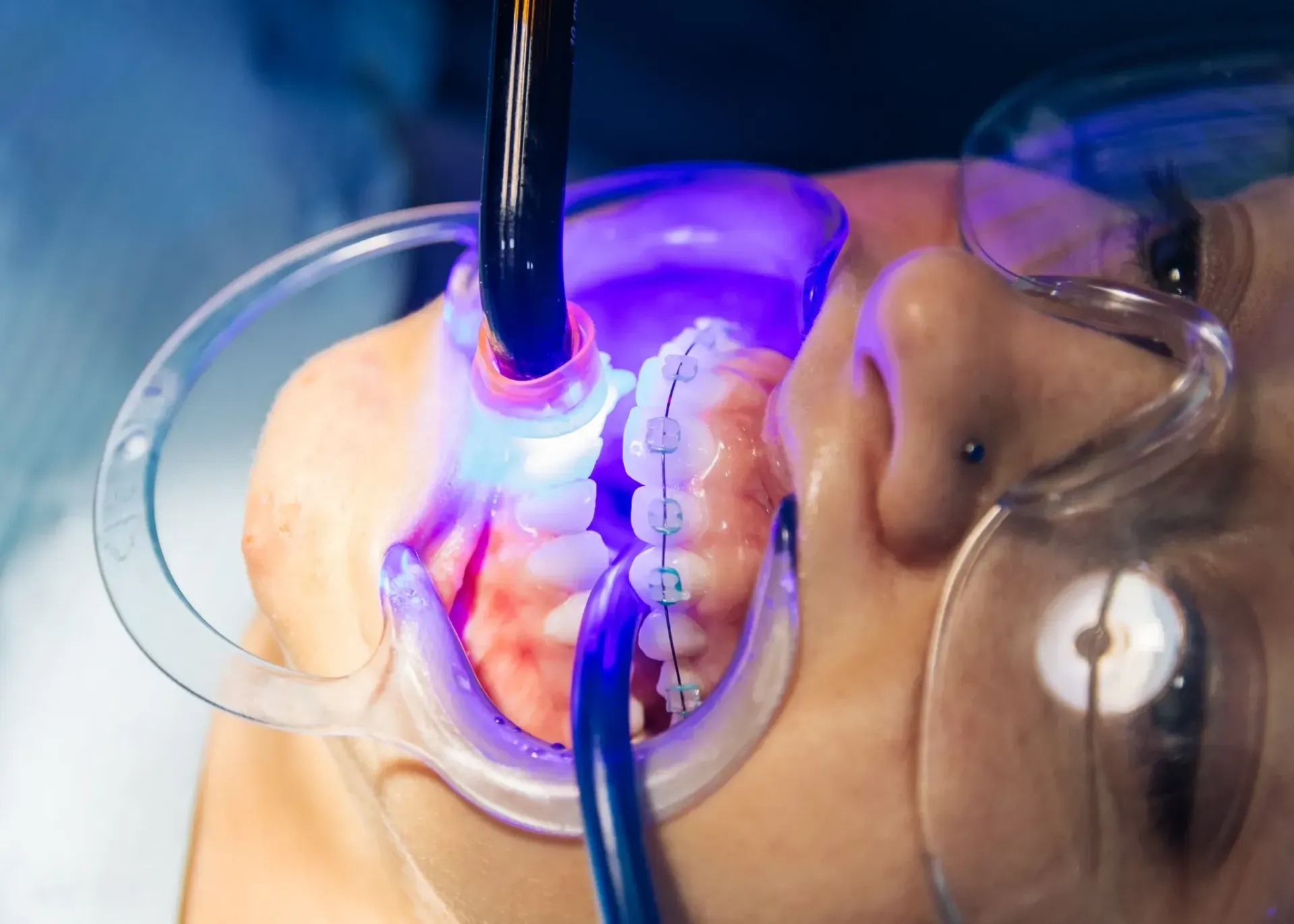 Trabajo dental en dientes con aparatos ortopédicos; luz azul brillante dirigida a la boca.