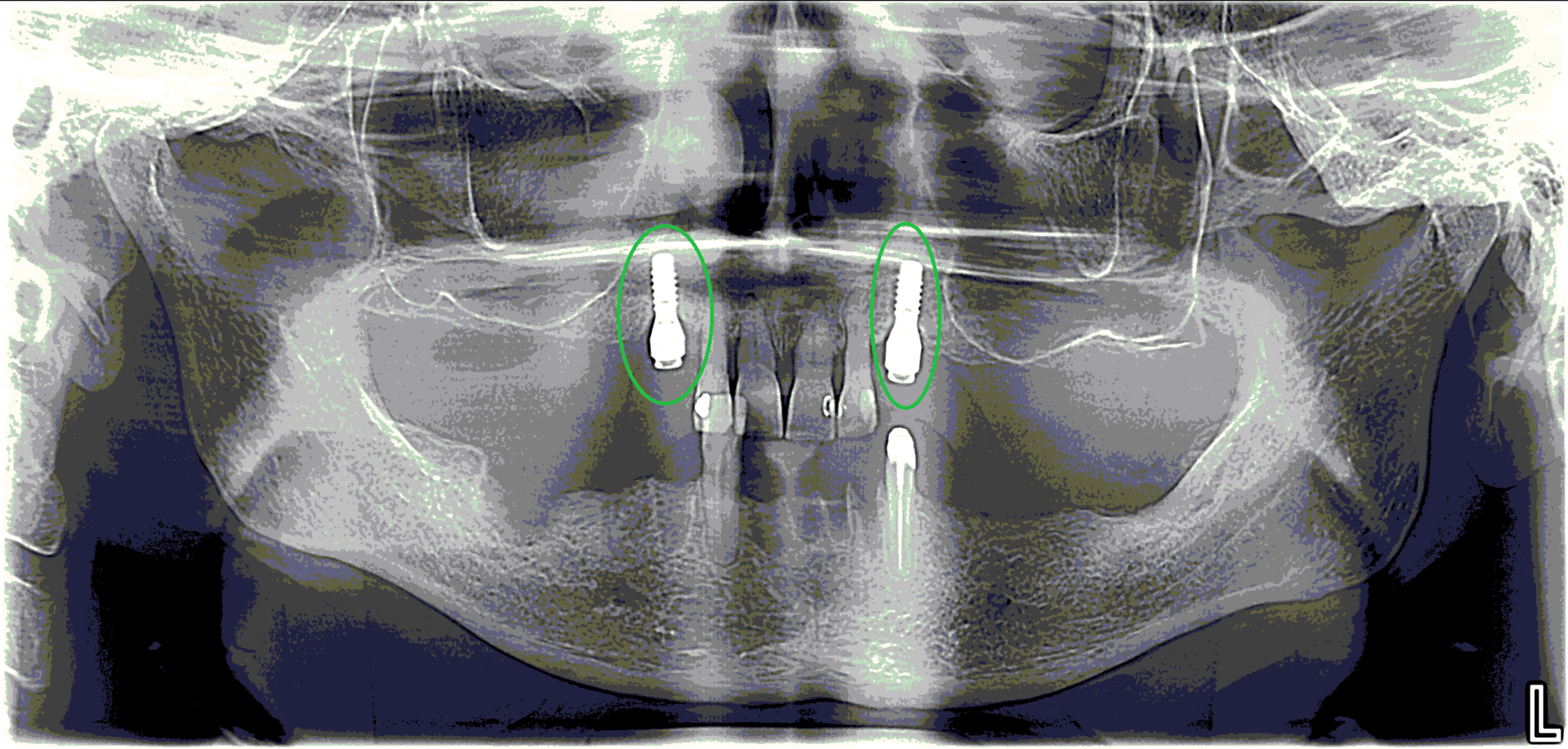 RX - Kontrollbild von zwei Implantaten
