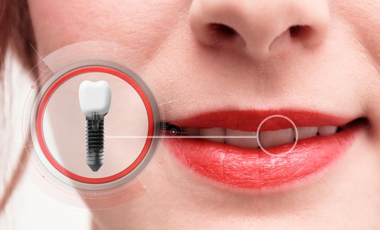 implantate - Seedent Ihre Zahnarztpraxis Dr. med. dent. Nies