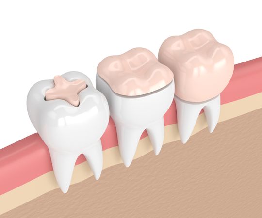 Zahnfüllungen - Seedent Ihre Zahnarztpraxis Dr. med. dent. Nies