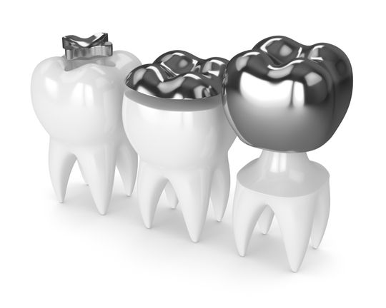 Amalgamsanierung - Seedent Ihre Zahnarztpraxis Dr. med. dent. Nies