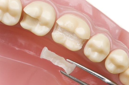 Zahnersatz - Seedent Ihre Zahnarztpraxis Dr. med. dent. Nies