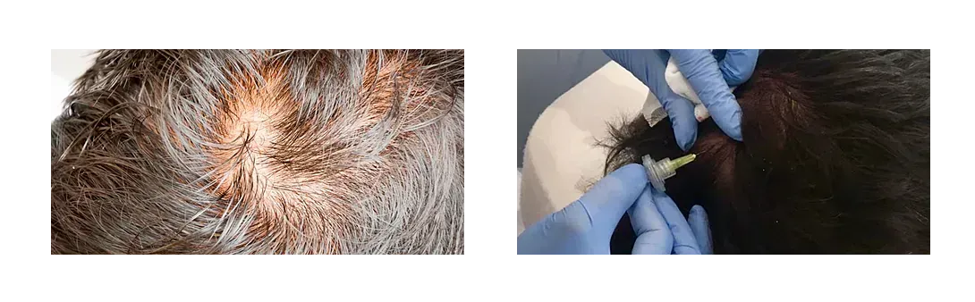 Una fotografía de antes y después de la cabeza de una persona con pérdida de cabello.