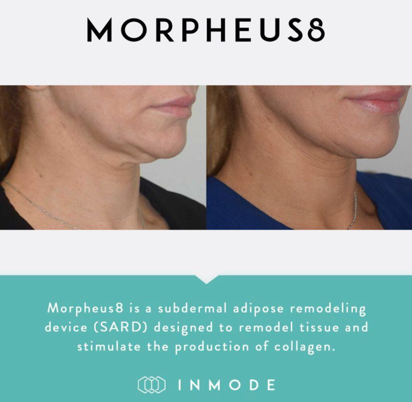 Skin Rejuvenation Results