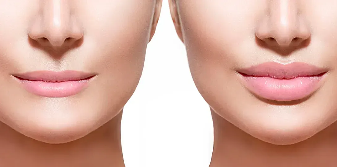 Una foto de antes y después de los labios de una mujer.
