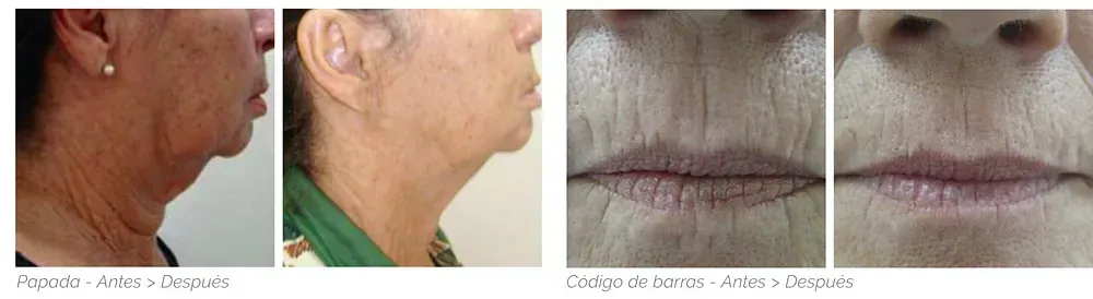 Una fotografía de antes y después del rostro de una mujer.