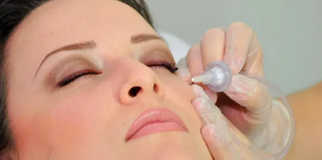 Rostro de una mujer durante un procedimiento cosmético. Una mano enguantada sostiene una herramienta cerca de su mejilla.