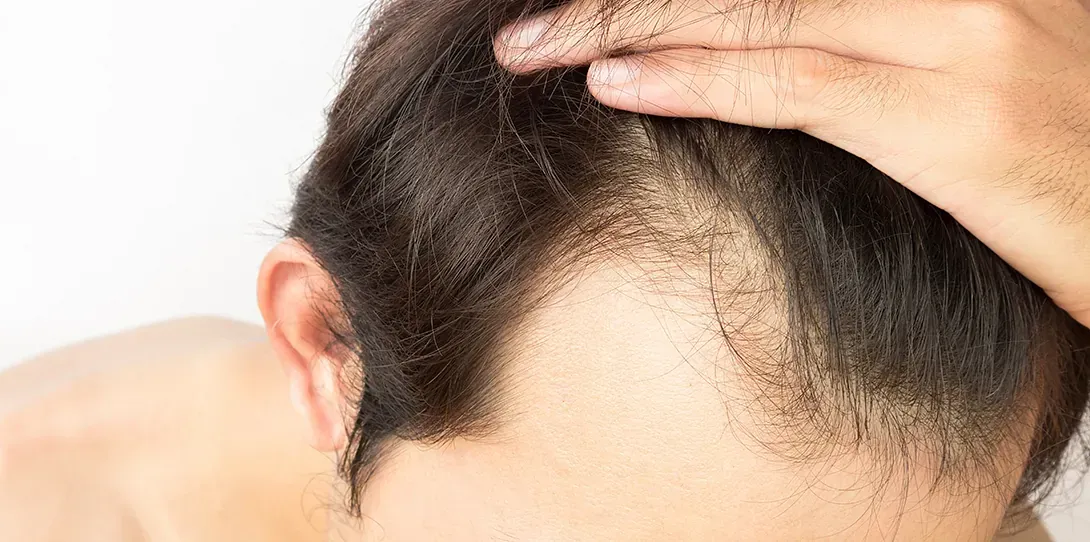 Un hombre con barba se toca el pelo con la mano.