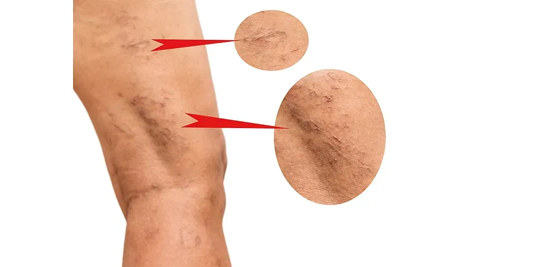 Un primer plano de la pierna de una persona con venas varicosas.