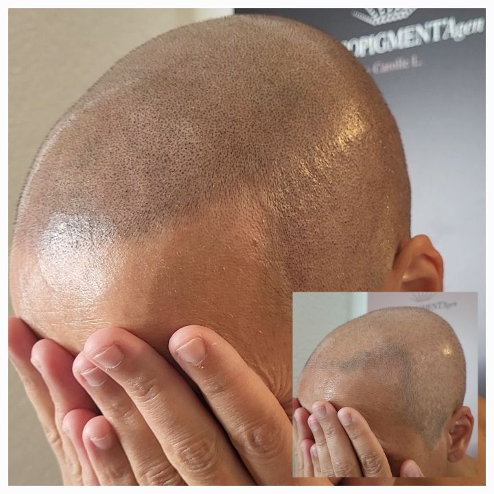 Tricopigmentation