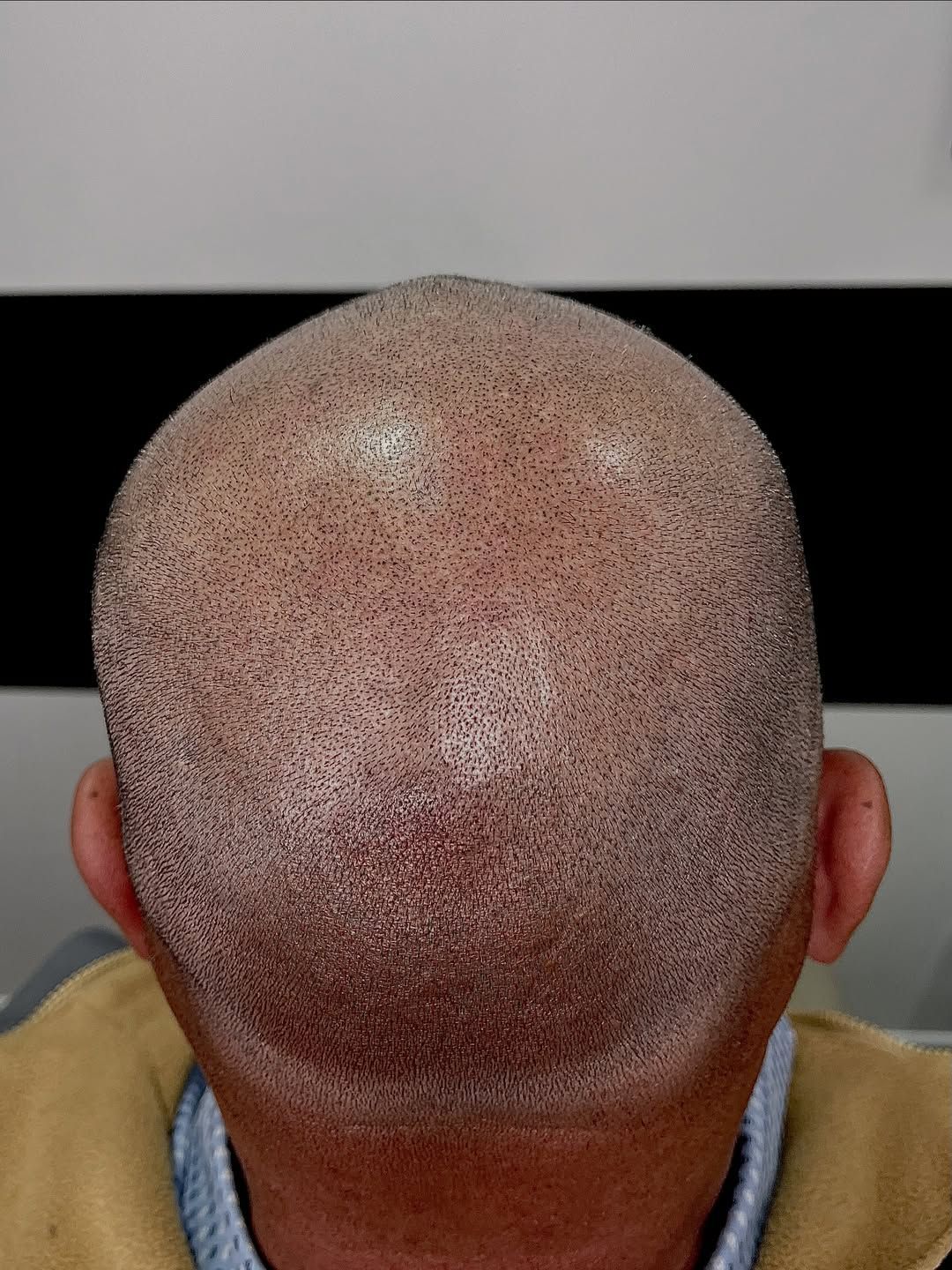 Primer plano de la parte posterior de la cabeza rapada de una persona, donde se aprecian numerosas manchas 