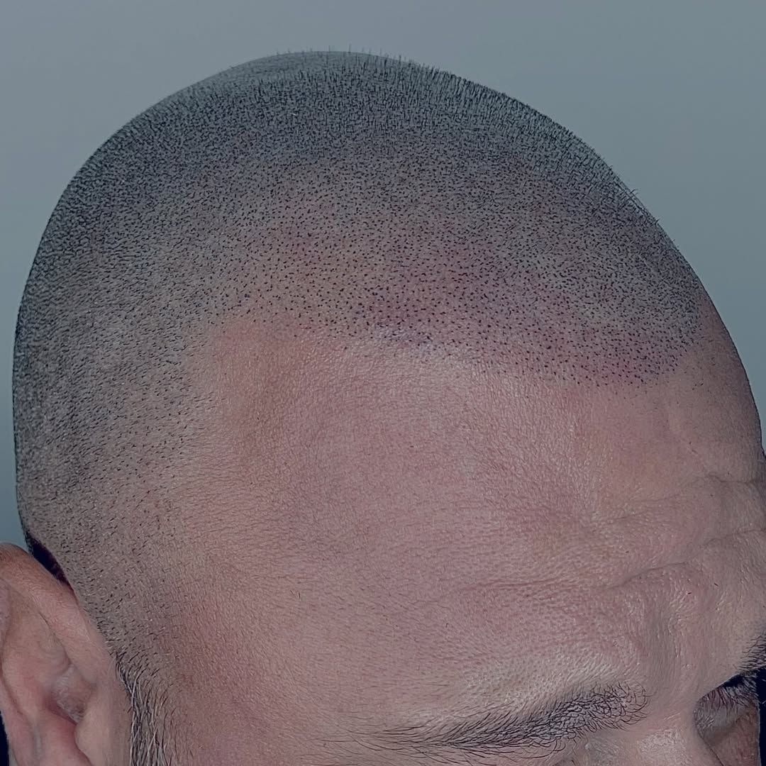 Primer plano lateral de la cabeza de un hombre, con la línea del cabello tratada con micropigmentación capilar