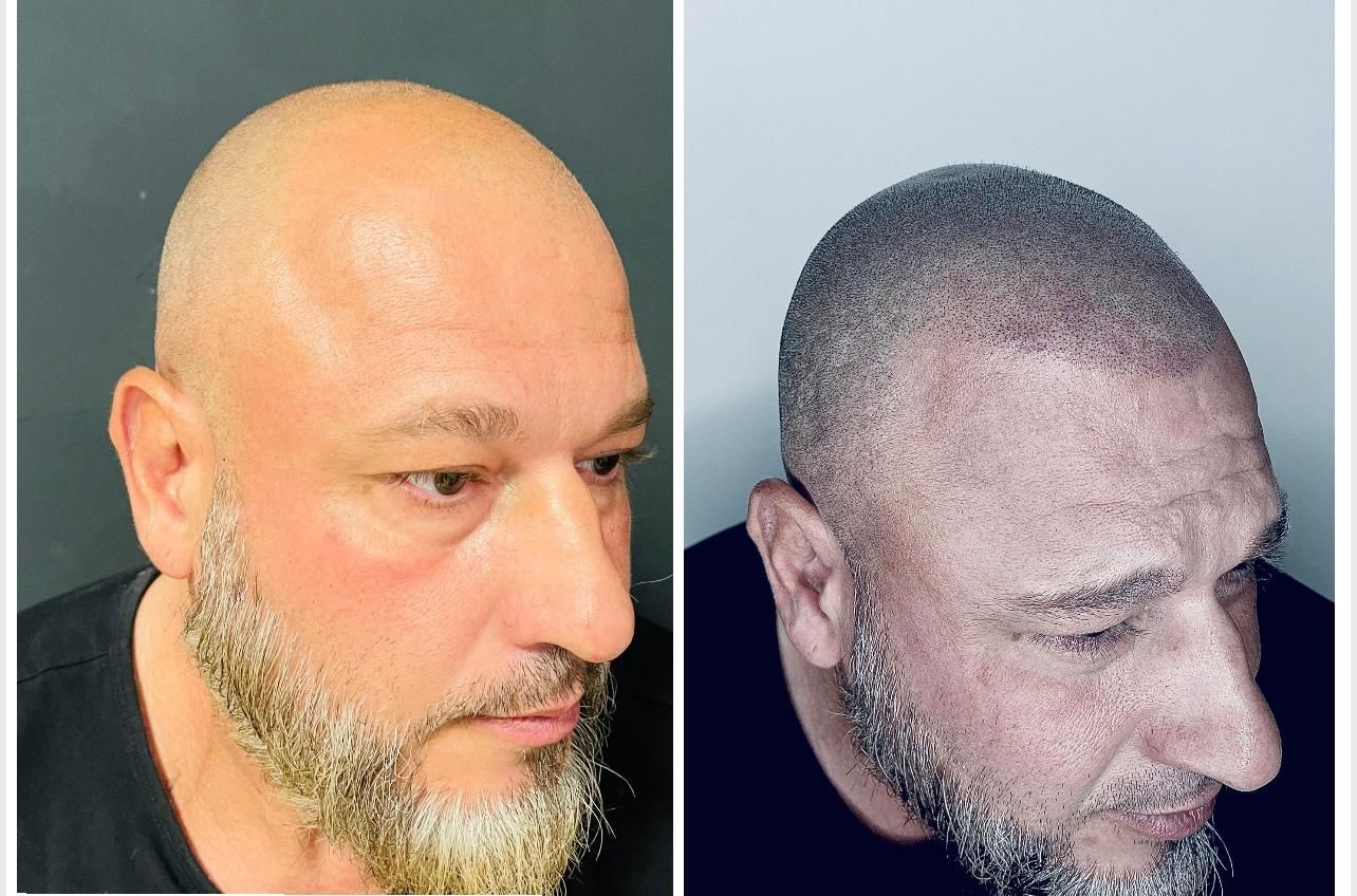 Primer plano de un cuero cabelludo humano que muestra pequeños folículos pilosos oscuros después de un trasplante de cabello