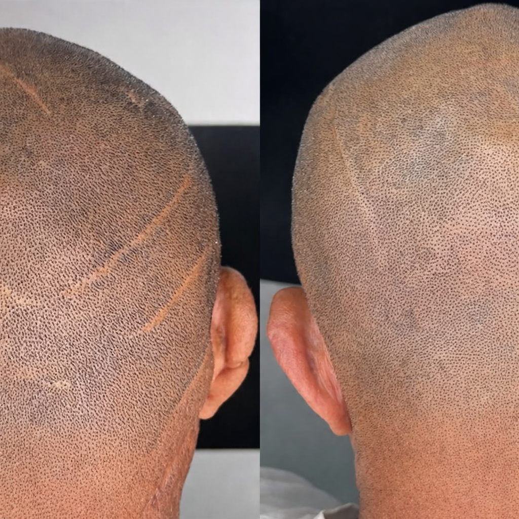 Comparación del antes y el después de un procedimiento de micropigmentación capilar