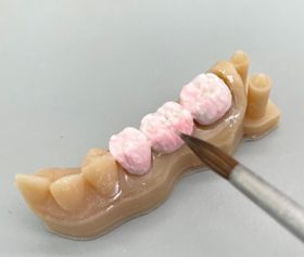 Prothèses dentaire fixe