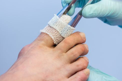 Ein Arzt legt einer Frau mit einer Pinzette einen Verband um den Zehennagel