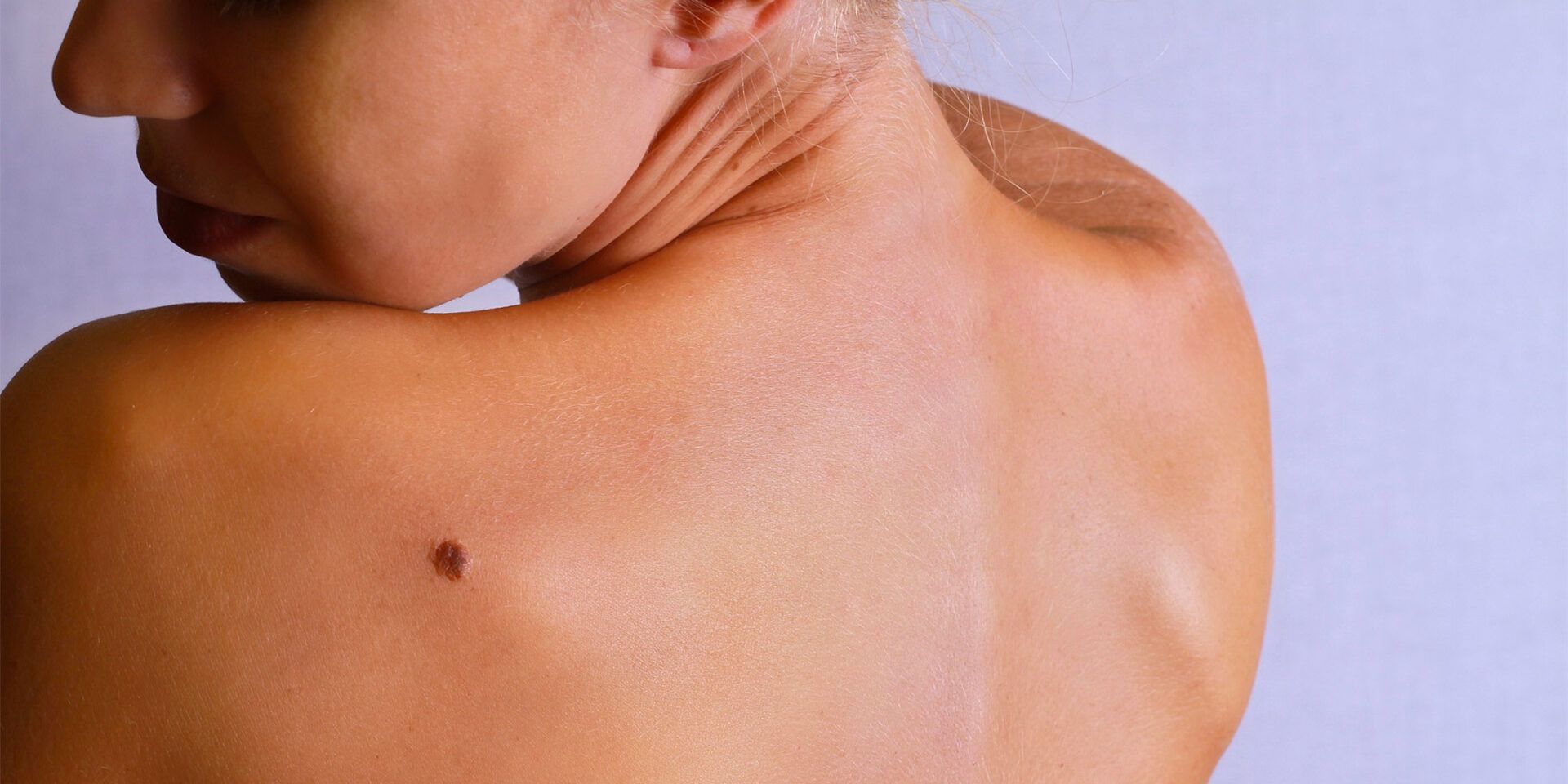 Spalla e schiena di una persona con un neo sulla spalla, rivolta verso sinistra.