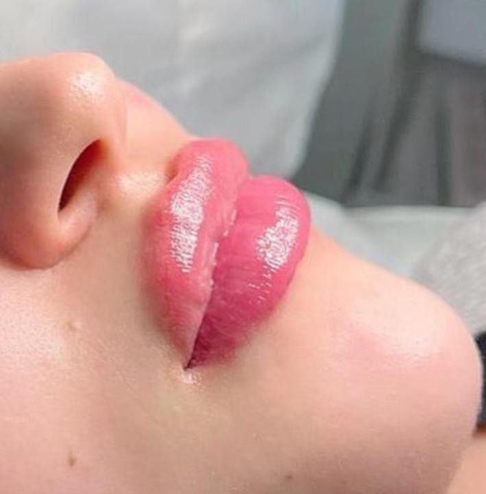 Nahaufnahme des Gesichts einer Person mit geschwollenen, rosa Lippen und einem Teil der Nase.