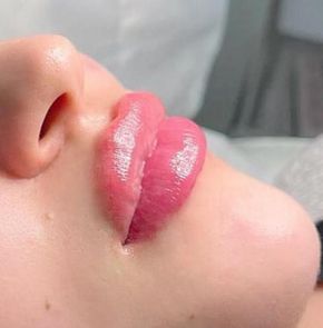 Nahaufnahme des Gesichts einer Person mit geschwollenen, rosa Lippen und einem Teil der Nase.